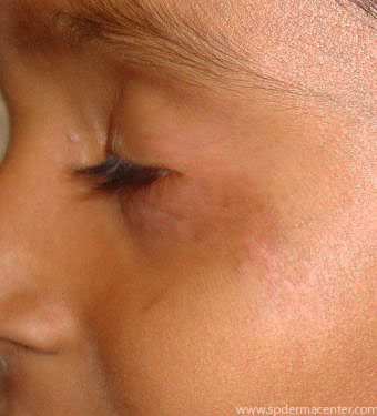 Vitiligo-After